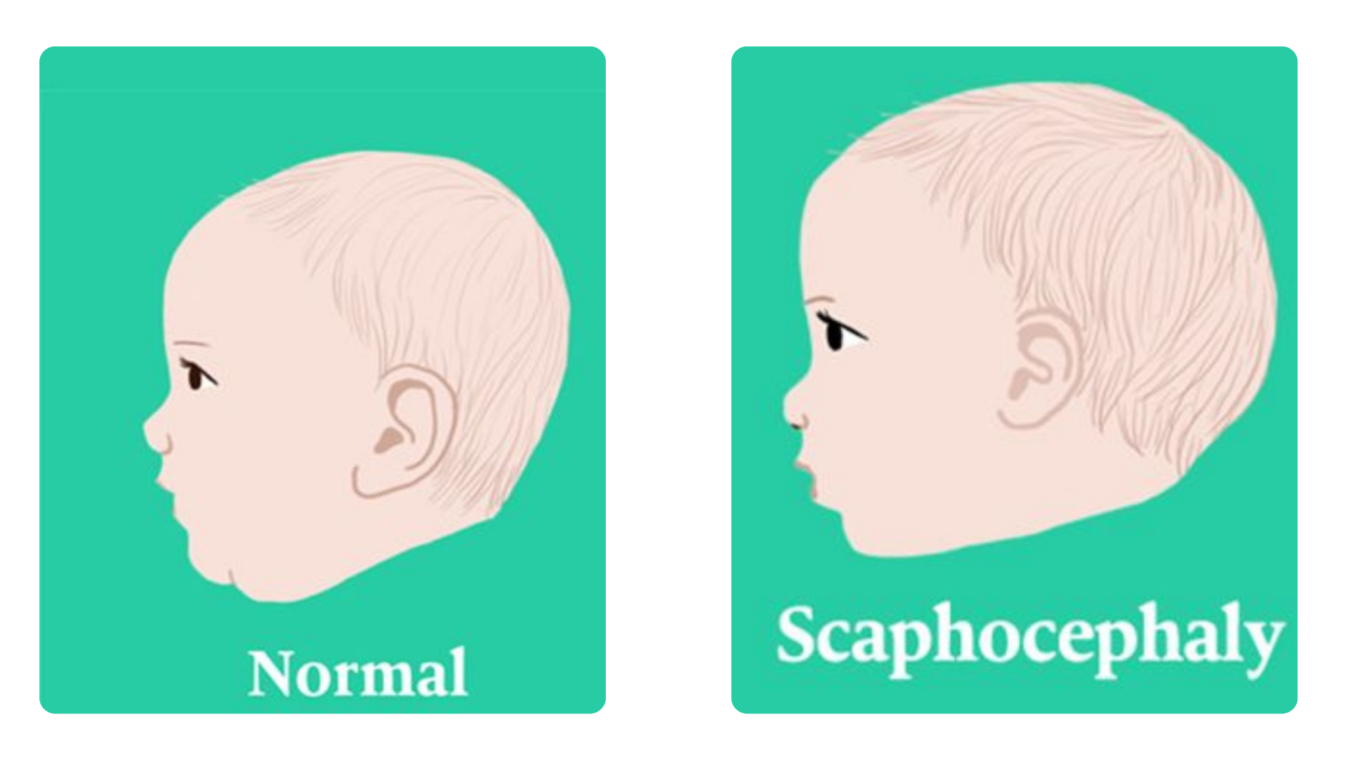 scaphocephaly
